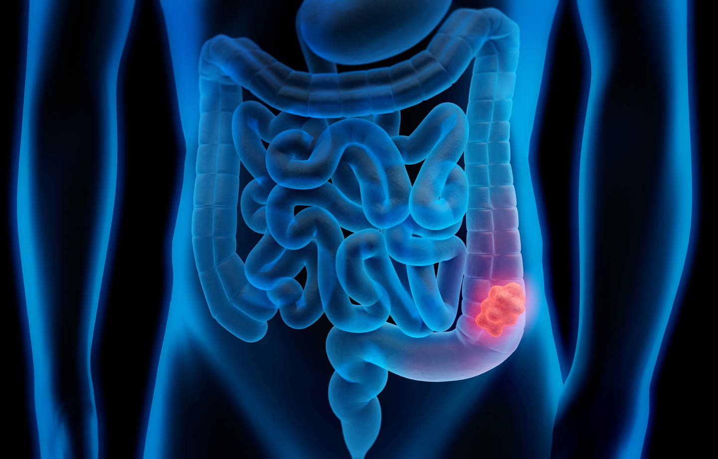 What is Colorectal Cancer?