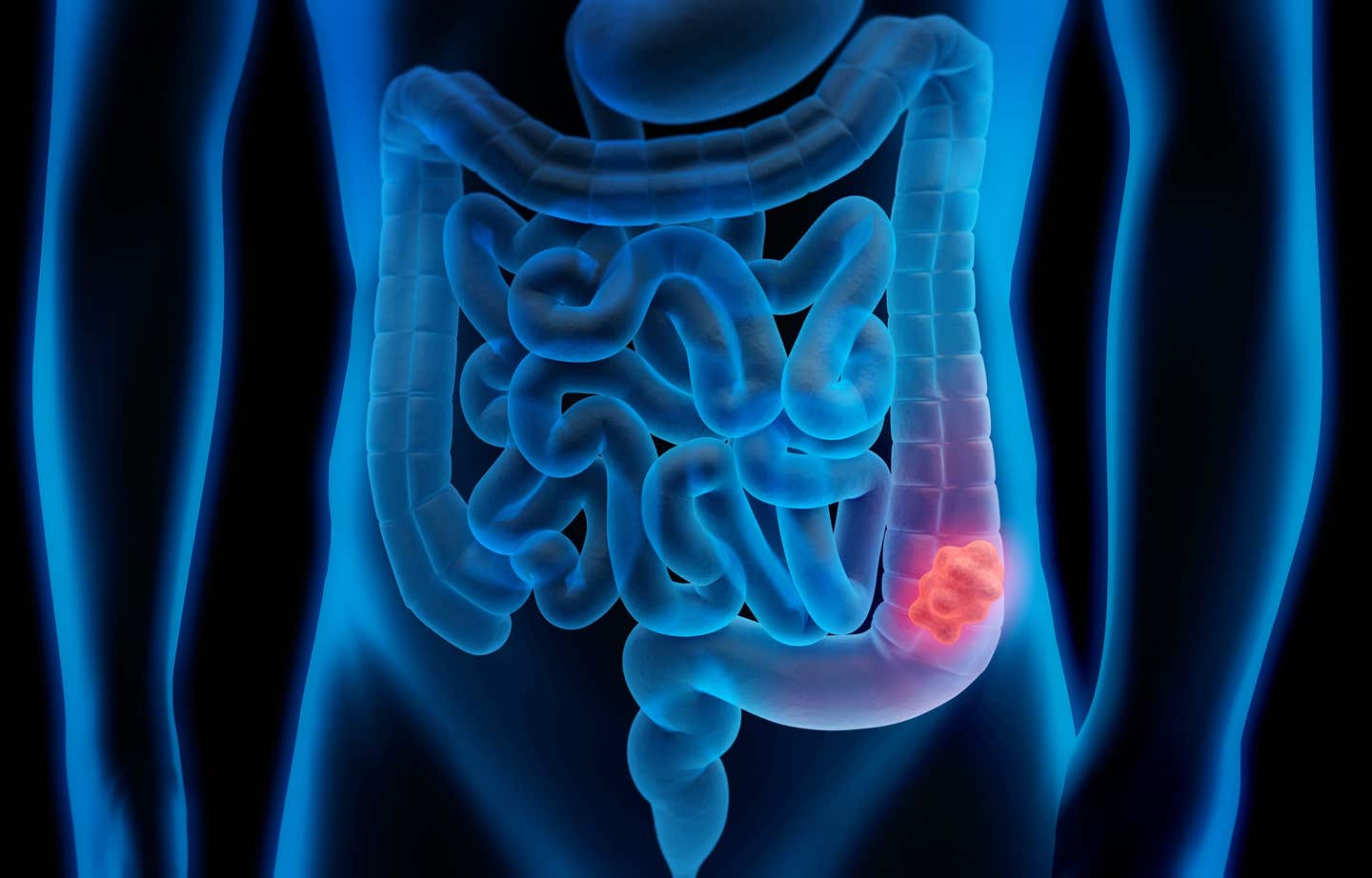 What is Colorectal Cancer?